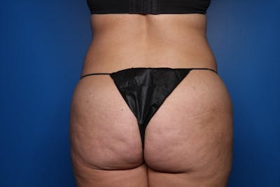BodyTite™ Before & After Gallery - Patient 367953 - Image 1