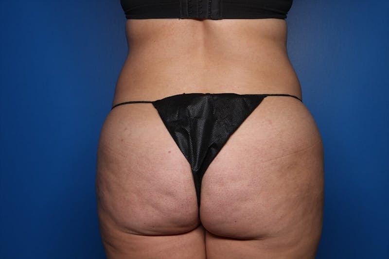 BodyTite™ Before and After Before & After Gallery - Patient 367953 - Image 1