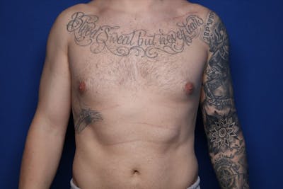 Gynecomastia (Male Breast Reduction) Before & After Gallery - Patient 860284 - Image 1