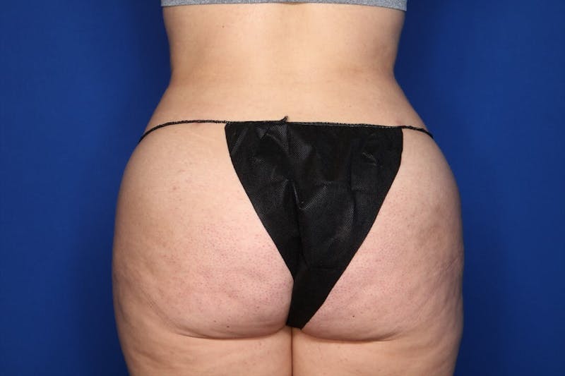 BodyTite™ Before and After Before & After Gallery - Patient 367953 - Image 2