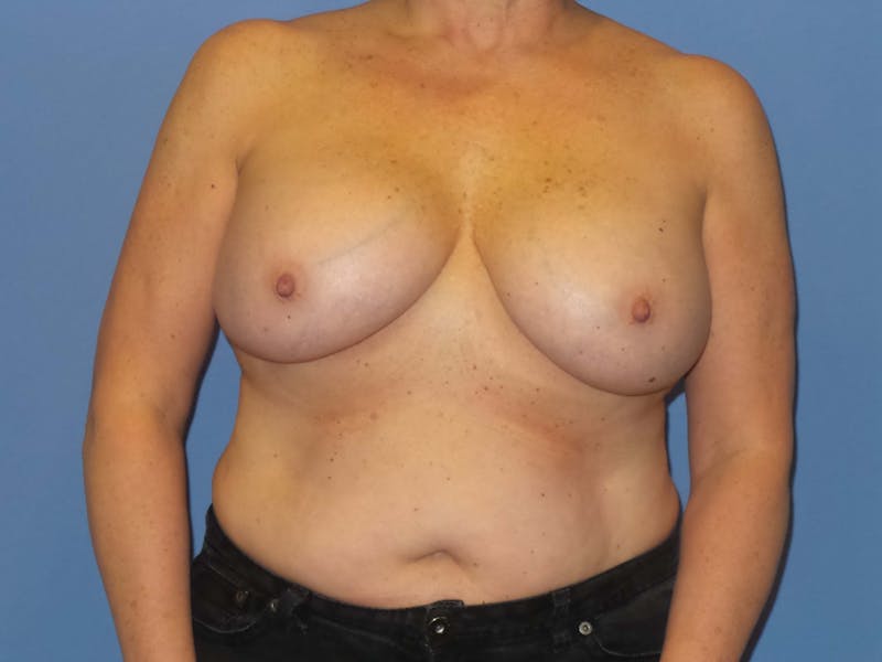 Breast Lift Before & After Gallery - Patient 866099 - Image 2