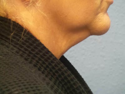 FaceTite Before and After Before & After Gallery - Patient 134935 - Image 1
