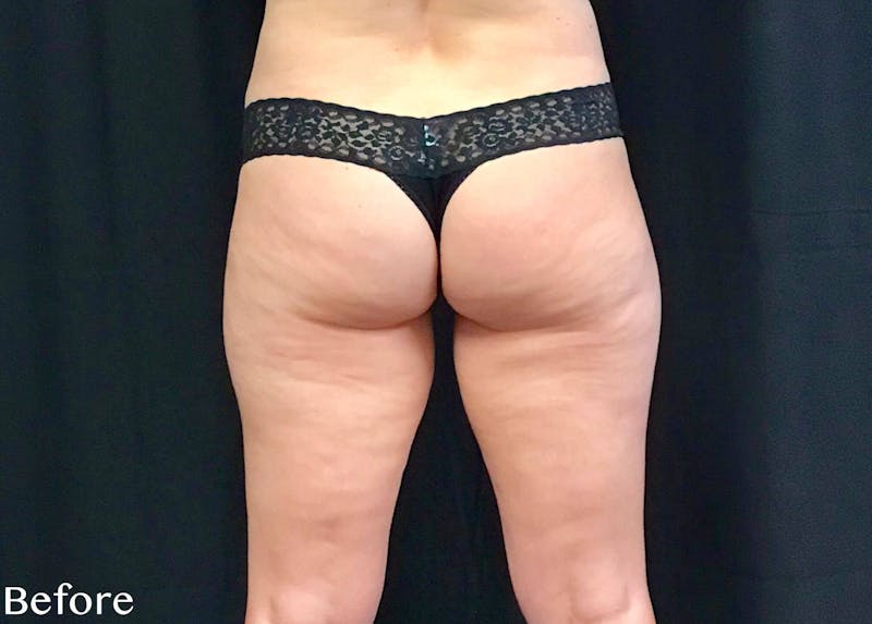 CoolSculpting® Before & After Gallery - Patient 386306 - Image 1