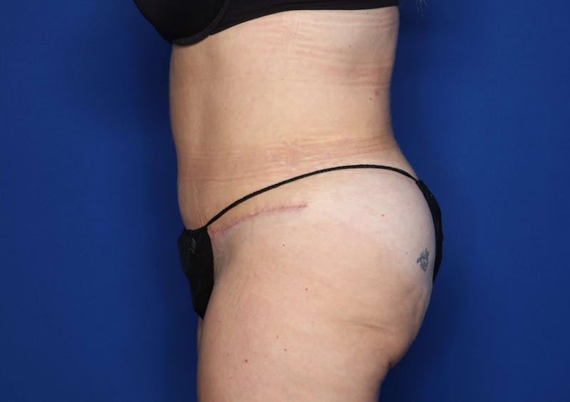 Tummy Tuck Before & After Gallery - Patient 707789 - Image 4