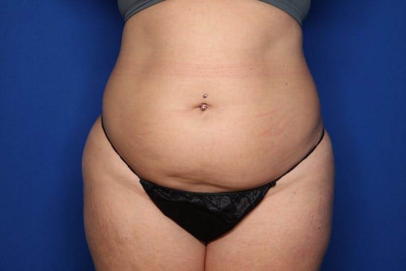 BodyTite™ Before and After Before & After Gallery - Patient 367953 - Image 5