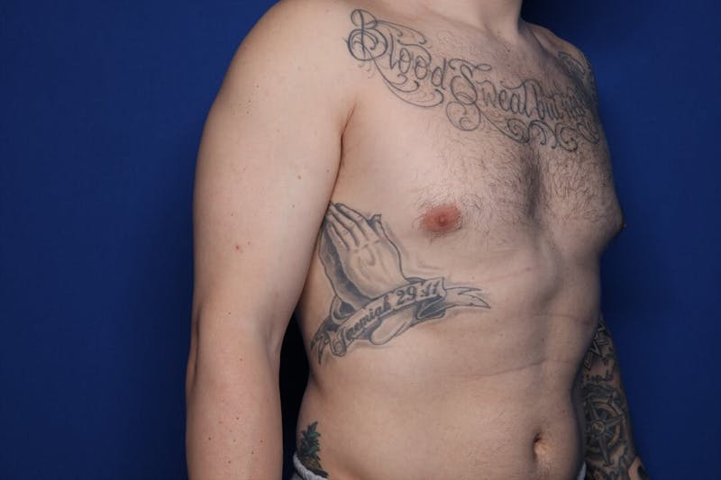 Gynecomastia (Male Breast Reduction) Before & After Gallery - Patient 860284 - Image 5