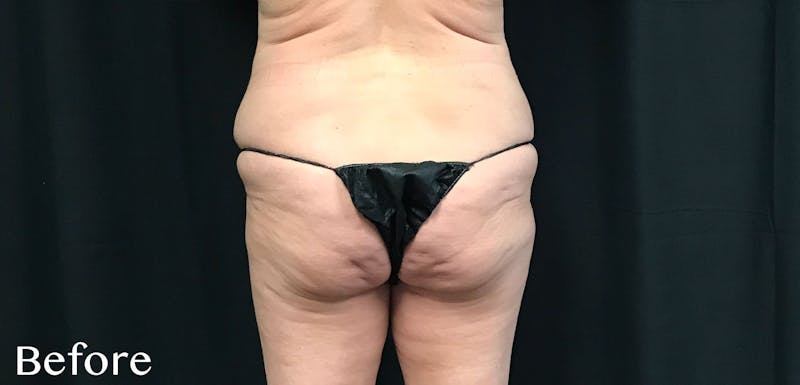 CoolSculpting® Before & After Gallery - Patient 187011 - Image 1