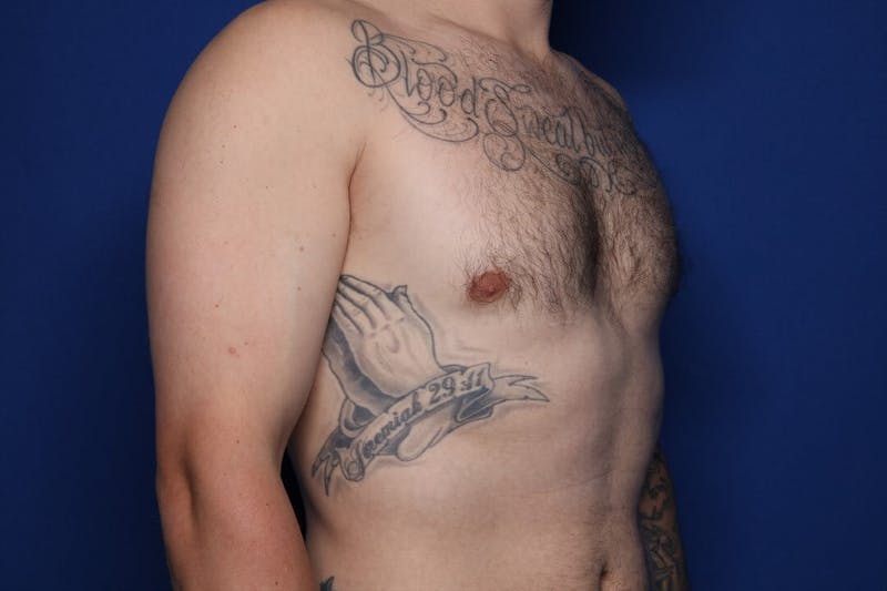 Gynecomastia (Male Breast Reduction) Before & After Gallery - Patient 860284 - Image 6