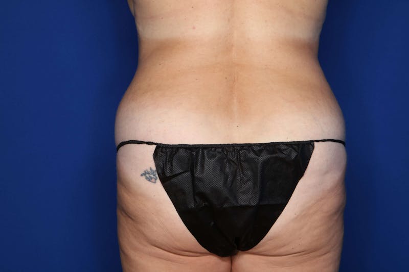 Tummy Tuck Before & After Gallery - Patient 707789 - Image 5