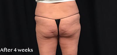 CoolSculpting® Before & After Gallery - Patient 187011 - Image 2
