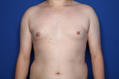 Gynecomastia (Male Breast Reduction) Before & After Gallery - Patient 410555 - Image 1