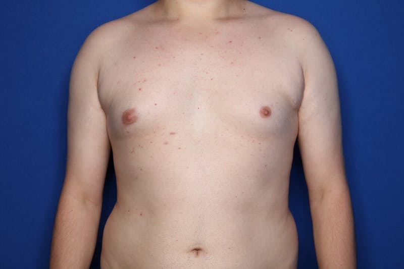 Gynecomastia (Male Breast Reduction) Before & After Gallery - Patient 410555 - Image 1