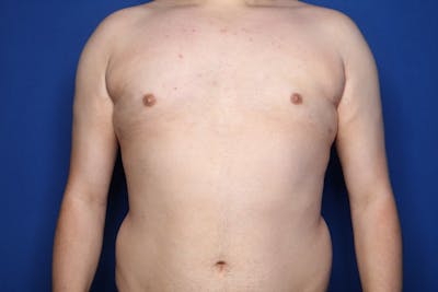 Gynecomastia (Male Breast Reduction) Before & After Gallery - Patient 410555 - Image 2