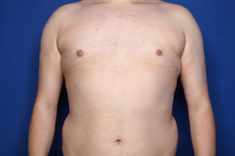 Gynecomastia (Male Breast Reduction) Before & After Gallery - Patient 410555 - Image 2