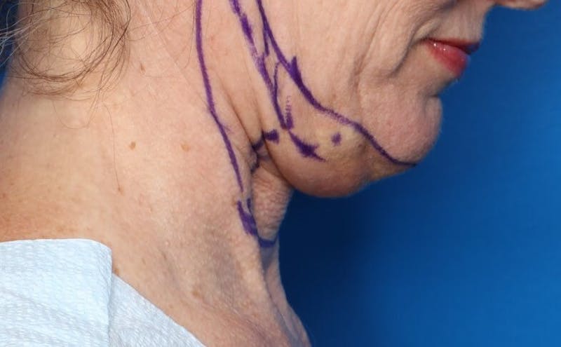FaceTite Before and After Before & After Gallery - Patient 854461 - Image 3