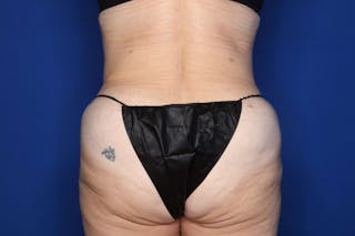 Tummy Tuck Before & After Gallery - Patient 707789 - Image 6