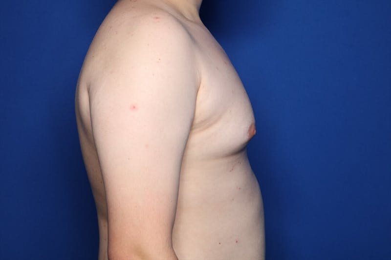 Gynecomastia (Male Breast Reduction) Before & After Gallery - Patient 410555 - Image 3