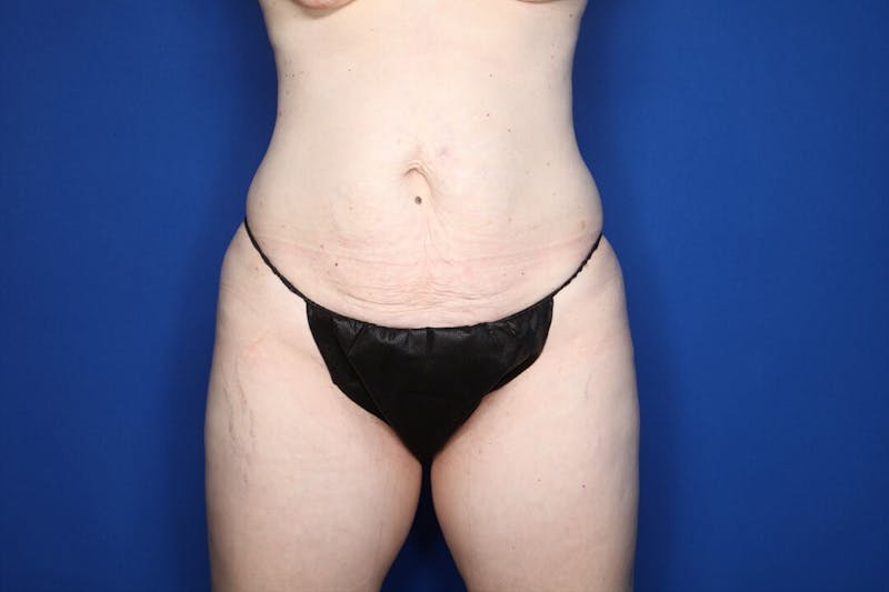 Breast Augmentation + Lift Before & After Gallery - Patient 159864 - Image 5