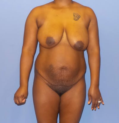 Breast Lift Before & After Gallery - Patient 300633 - Image 1