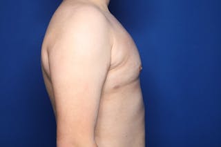 Gynecomastia (Male Breast Reduction) Before & After Gallery - Patient 410555 - Image 4