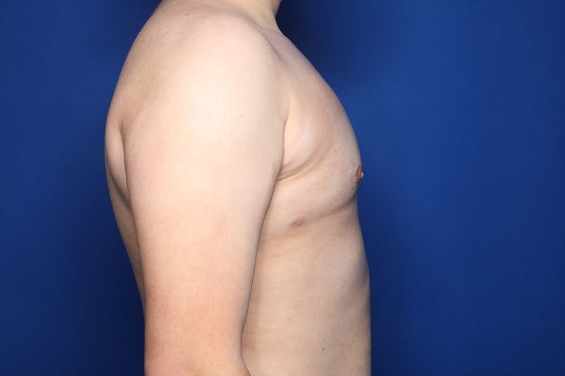 Gynecomastia (Male Breast Reduction) Before & After Gallery - Patient 410555 - Image 4
