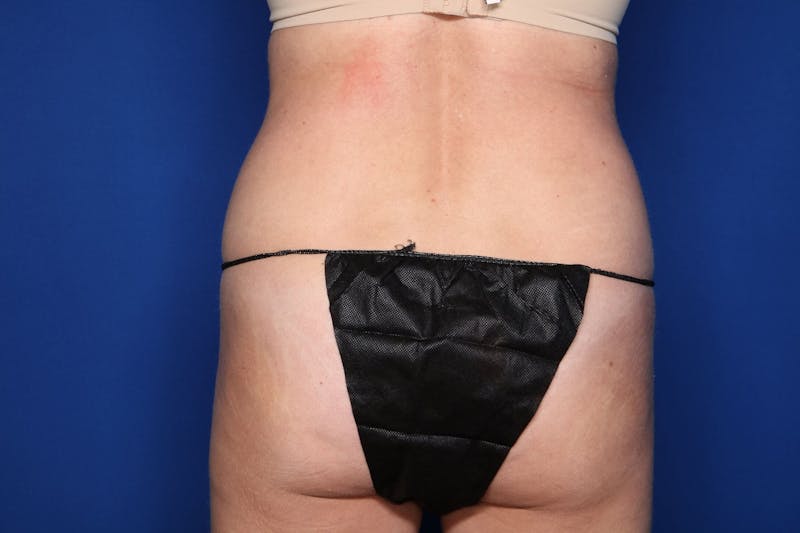 BodyTite™ Before & After Gallery - Patient 437377 - Image 5