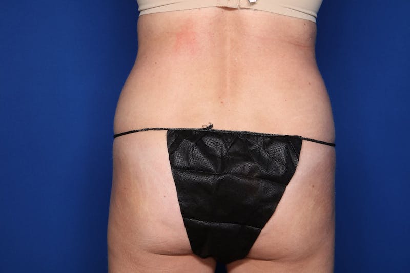 BodyTite™ Before and After Before & After Gallery - Patient 437377 - Image 5