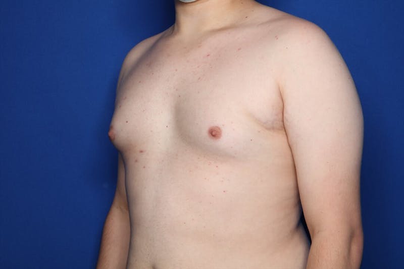 Gynecomastia (Male Breast Reduction) Before & After Gallery - Patient 410555 - Image 5