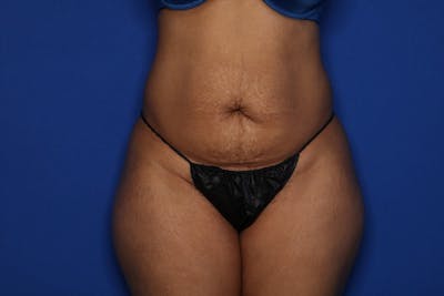 Tummy Tuck Before & After Gallery - Patient 336801 - Image 1