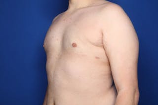 Gynecomastia (Male Breast Reduction) Before & After Gallery - Patient 410555 - Image 6