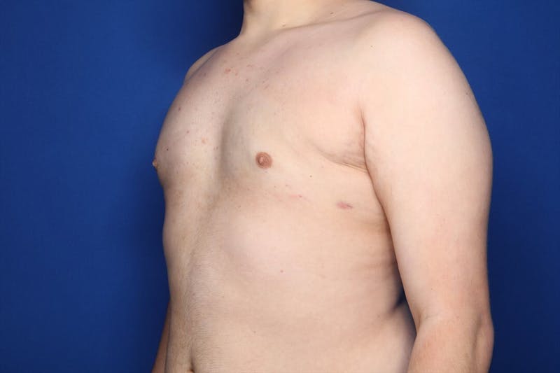 Gynecomastia (Male Breast Reduction) Before & After Gallery - Patient 410555 - Image 6