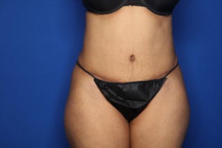Tummy Tuck Before & After Gallery - Patient 336801 - Image 2