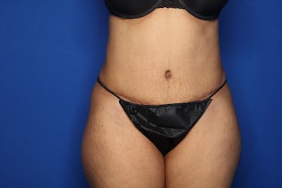 Tummy Tuck Before & After Gallery - Patient 336801 - Image 2