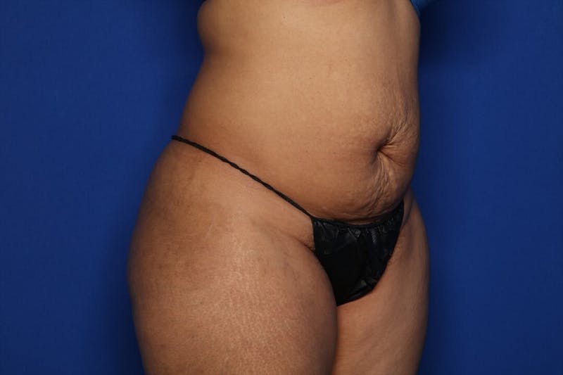 Tummy Tuck Before & After Gallery - Patient 336801 - Image 3