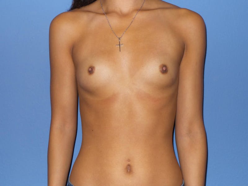 Breast Augmentation Before & After Gallery - Patient 237219 - Image 1