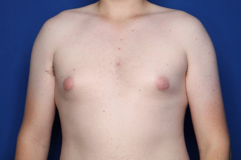 Gynecomastia (Male Breast Reduction) Before & After Gallery - Patient 255688 - Image 1
