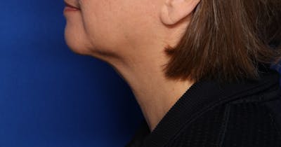 FaceTite™ Before & After Gallery - Patient 396234 - Image 2