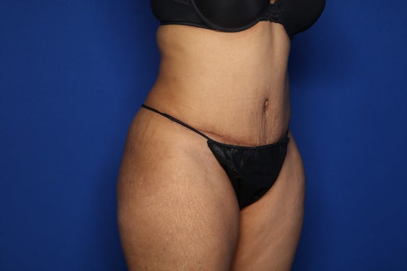 Tummy Tuck Before & After Gallery - Patient 336801 - Image 4