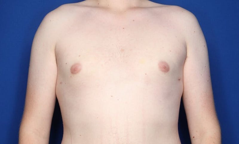 Gynecomastia (Male Breast Reduction) Before & After Gallery - Patient 255688 - Image 2