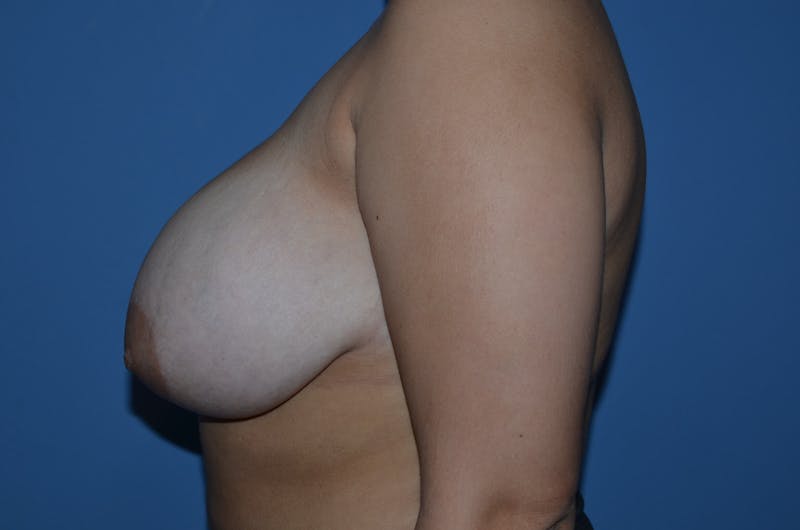 Breast Reduction Before & After Gallery - Patient 191160 - Image 3