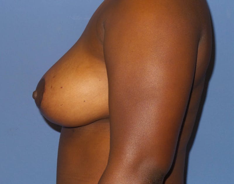 Breast Lift Before & After Gallery - Patient 300633 - Image 4