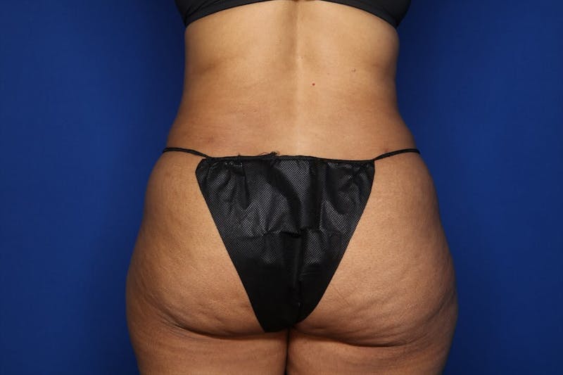 Tummy Tuck Before & After Gallery - Patient 336801 - Image 6