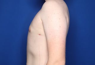 Gynecomastia (Male Breast Reduction) Before & After Gallery - Patient 255688 - Image 4