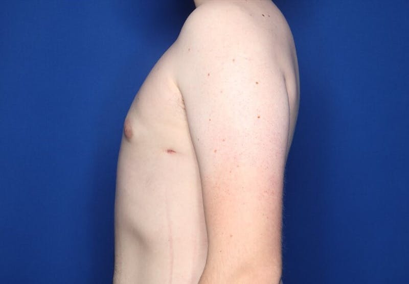 Gynecomastia (Male Breast Reduction) Before & After Gallery - Patient 255688 - Image 4