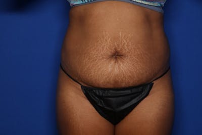 Liposuction Before & After Gallery - Patient 297940 - Image 1