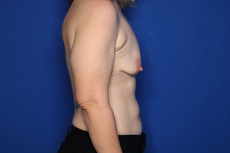 Breast Augmentation + Lift Before & After Gallery - Patient 149541 - Image 5