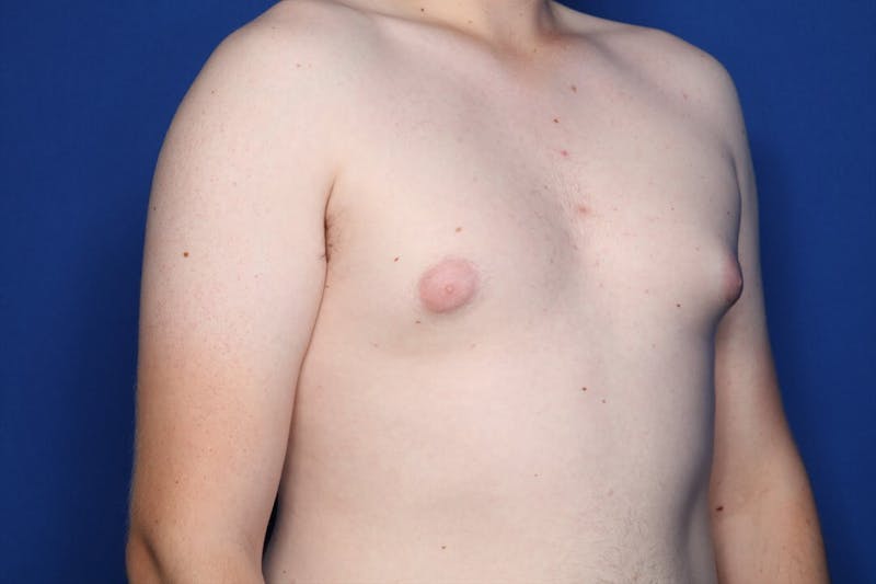 Gynecomastia (Male Breast Reduction) Before & After Gallery - Patient 255688 - Image 5