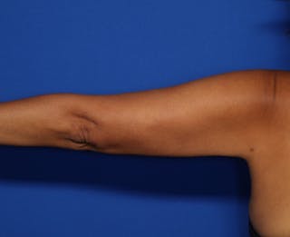 BodyTite™ Before and After Before & After Gallery - Patient 390806 - Image 2