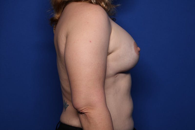 Breast Augmentation + Lift Before & After Gallery - Patient 149541 - Image 6