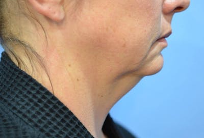 FaceTite Before and After Before & After Gallery - Patient 735186 - Image 1